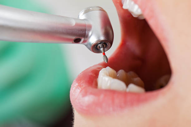 Best Emergency Dental Care for Broken or Chipped Teeth in Soledad, CA
